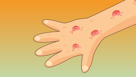 How To Get Rid of Mosquito Bite Scars