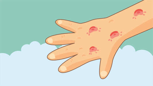 Mosquito Bite Scars: Causes, Itch Relief, How Long They Last & More