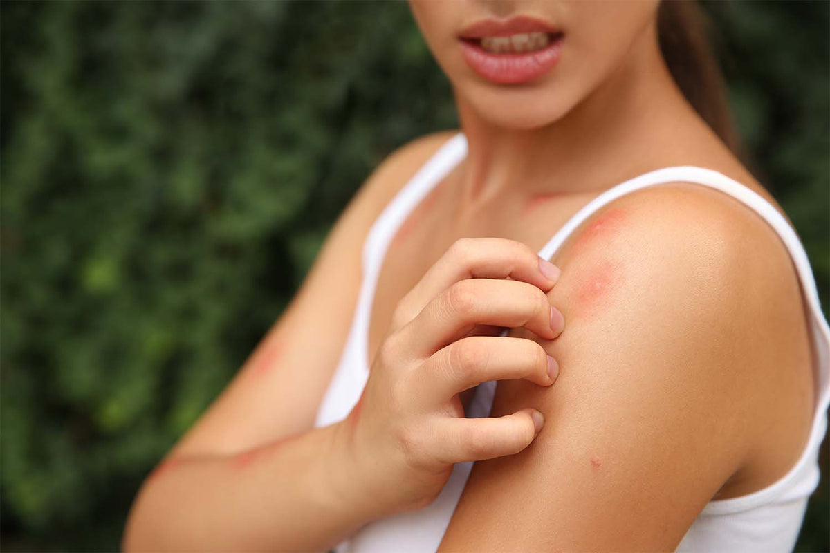 What To Do With Bug Bite That Won't Go Away | The Natural Patch Co