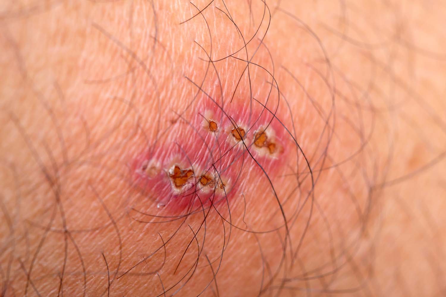 Wood Spider Bite