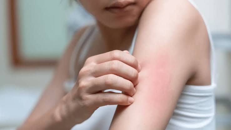 Person scratching a red, irritated mosquito bite on their upper arm, showing skin sensitivity.